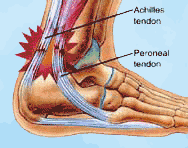Ankle Sprain Podiatry Pictrue
